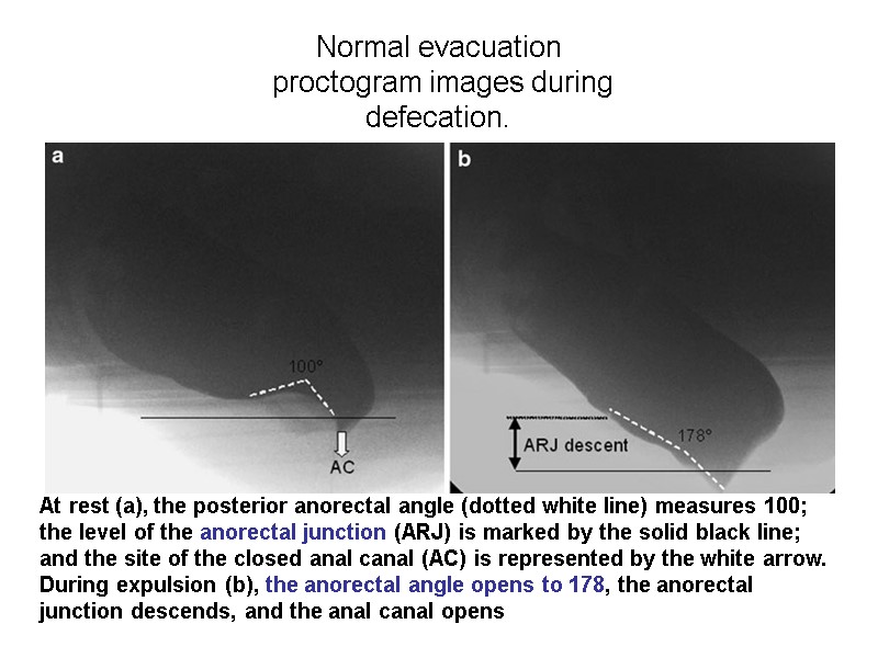 Normal evacuation  proctogram images during defecation. At rest (a), the posterior anorectal angle